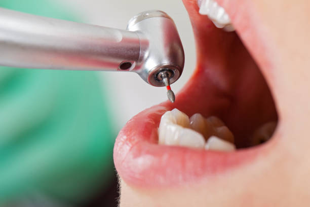 Best Emergency Wisdom Teeth Removal in Athens, TN